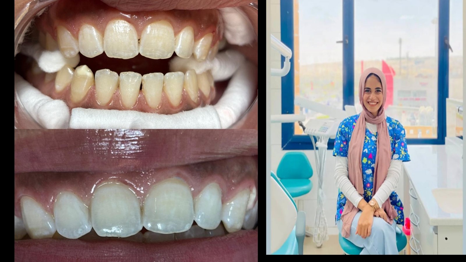 تبيض الاسنان - محمـــــد جابـــــر